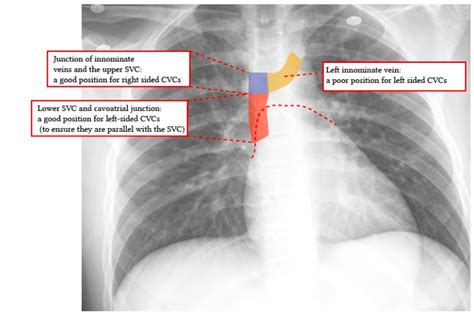 IDEAL POSITION OF TIP OF RIGHT IJV CATHETER – The Lay Medical Man