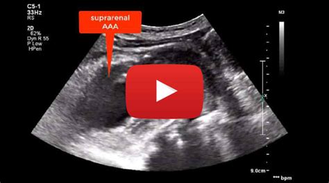 Suprarenal Abdominal Aortic Aneurysm Aaa In A Patient With A Previous