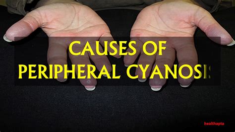 CAUSES OF PERIPHERAL CYANOSIS - YouTube