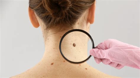 Moles On Each Location Of Your Body Explained Facial Mole Cancerous Moles Laser Removal Mole