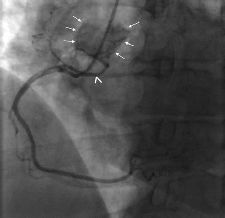 Cardiac Paraganglioma Circulation Cardiovascular Interventions