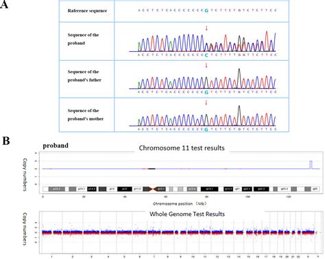 Case Report Wiedemann Steiner Syndrome With A New Frameshift Mutation