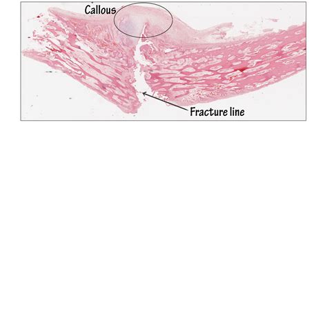 Pathology Glossary Bone Fracture Healing Draw It To Know It