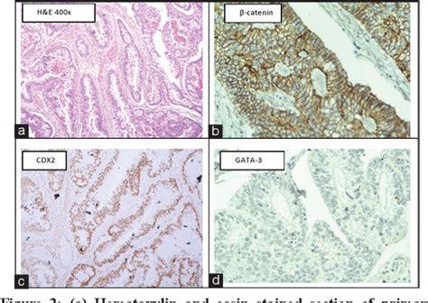 Figure 1 From Adenocarcinoma Of Urinary Bladder In A 55 Year Old Female