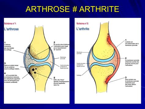 Quelle différence y a t il entre l arthrose et l arthrite