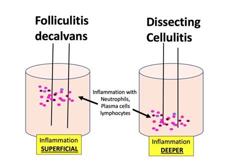 A Closer Look At The Location Of Inflammation In Folliculitis Decalvans Vs Dissecting Cellulitis