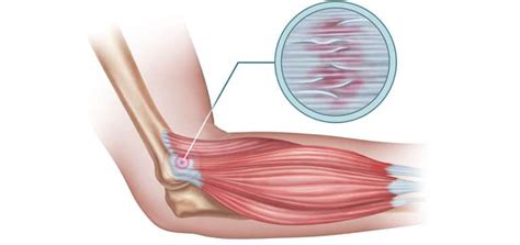 Epicondilite Gomito Del Tennista Cause Sintomi E Rimedi Project