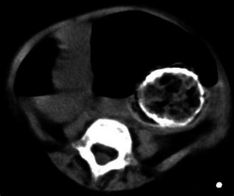 Abdomen Computed Tomography Showed The Mass Download Scientific Diagram