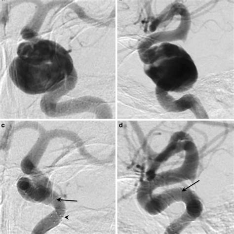 DSA Digital Subtraction Angiography Imaging Of A Large Aneurysm Of