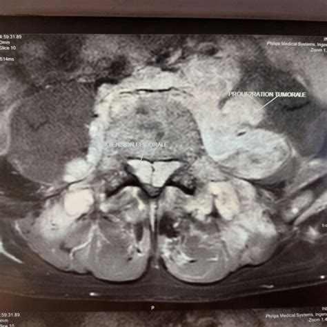 Cross section of a spinal cord MRI showing spinal cord compression at ...