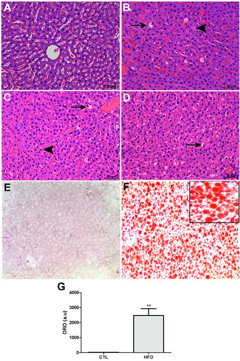 Evaluation Of Steatosis Inflammation And Lipid Deposition In The Liver