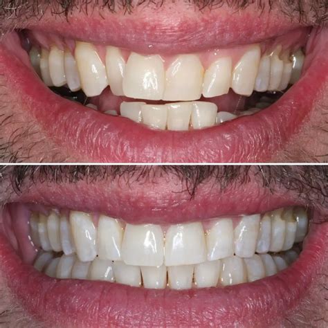 Transform Your Smile Invisalign Before And After