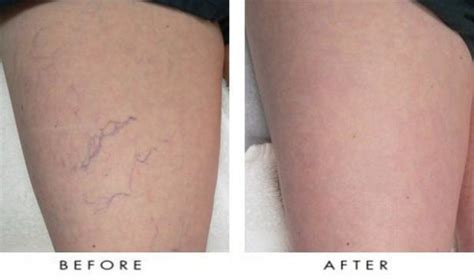 Laser Spider Vein Treatments Columbia Laser And Aesthetics Center