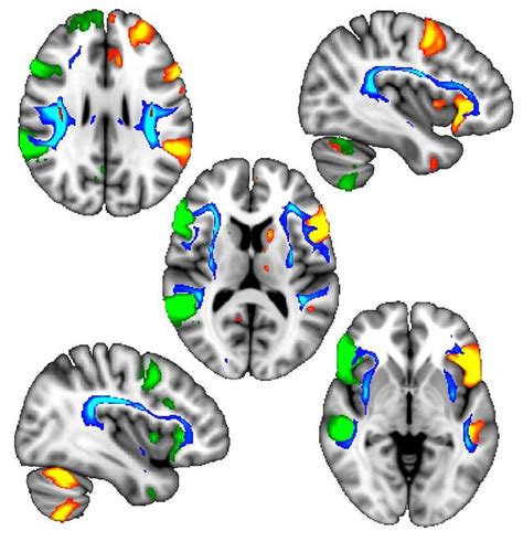 Handedness May Sway Right Brain–Left Brain Language Regions ...