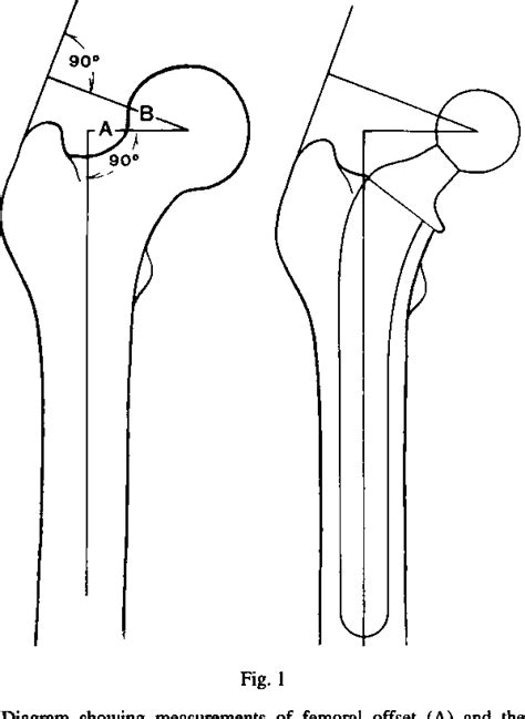 Figure From Effect Of Femoral Offset On Range Of Motion And Abductor