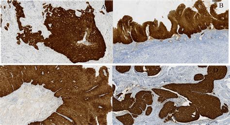 P16 Positive Expression On The Slides Of Every Site A D P16 Diffuse Download Scientific