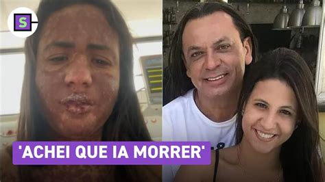 Mulher De Frank Aguiar Ficou Na Uti Por Doen A Rara Que Queima A Pele