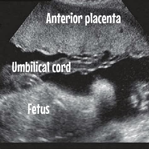 Everything About The Placenta Ultrasound Included Ultrasoundfeminsider