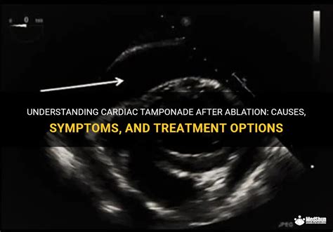 Understanding Cardiac Tamponade After Ablation Causes Symptoms And Treatment Options Medshun