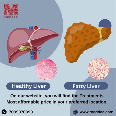 What Is The Best Way To Reverse A Fatty Liver At Lola Ives Blog