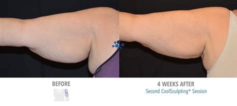 CoolSculpting - Before & After | Hannah Aesthetics