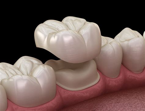 What Are Cerec Same Day Dental Crowns Restorative Dentistry