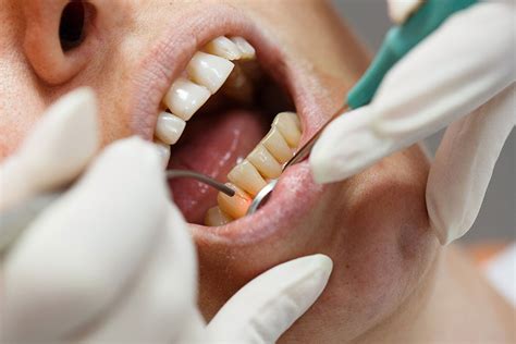 Soft Tissue Dental Laser Offers Many Dental Benefits