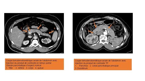 Radio Anatomie Normale Du Pancras Ses Variantes Et