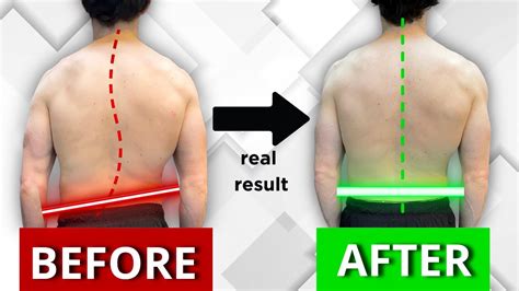 How To Actually Fix Your Scoliosis To Reduce Pain And Improve Movement Quality Results Driven