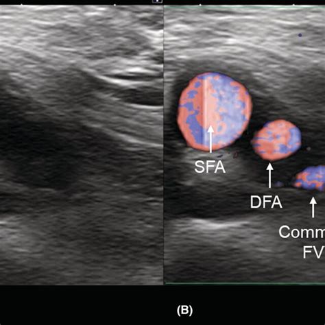 A B The 3d Ct Imaging Of The Right Groin A Anteroposterior View