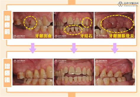 牙周病造成牙齦萎縮怎麼辦？牙周雷射治療有用嗎？ 品粹牙醫