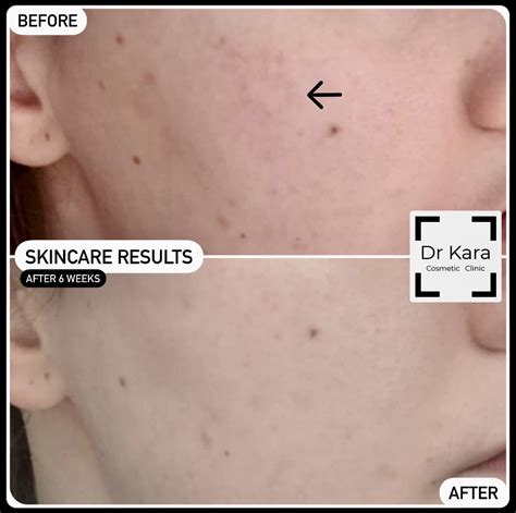 Results Dr Kara Cosmetic Clinic Norwich Aesthetics Skincare