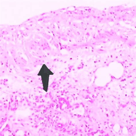 Photomicrograph H And E Stain Original Magnification ×25 Of The Cyst