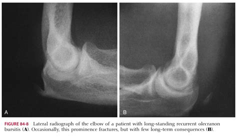 Olecranon Bursitis - General Components and Differential Diagnosis of ...