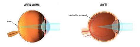 Miopía Clínica Oftalmológica Vista Sánchez Trancón