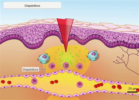 PodEduc La Réaction Inflammatoire