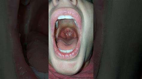 Swollen tonsil - YouTube