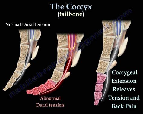 Coccyx pain