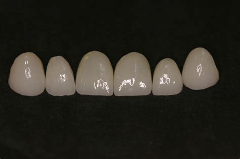 IPS E Max Porcelain Veneers Olivadds Porcelain Veneers