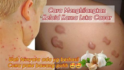 PART 13 QnA Cara Menghilangkan KELOID Bekas Luka CACAR Ternyata Ada