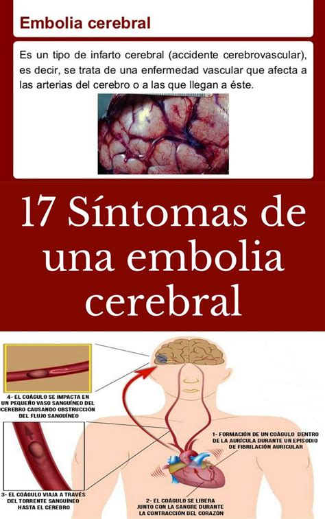 S Ntomas De Una Embolia Cerebral Tips Life Vida Salud Remedios