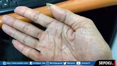 Penyebab Telapak Tangan Kanan Gatal Cameron Smith