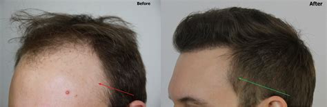 The Importance Of Temple Points In Hair Restoration Dr Baubac Examples Hair Transplant