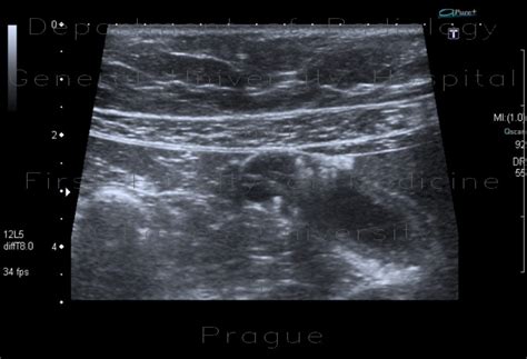 Radiology case: Adenomyosis of gallbladder, localized