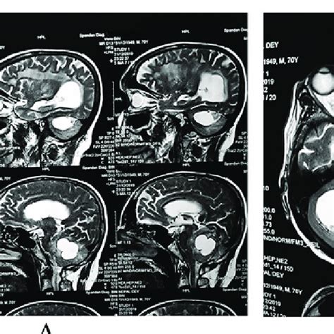 Sagittal T2 Weighted A And Axial T2 Weighted B Mri Images Reveal A