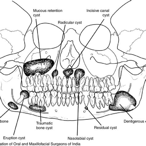 Pdf Cysts Of The Oro Maxillofacial Region”