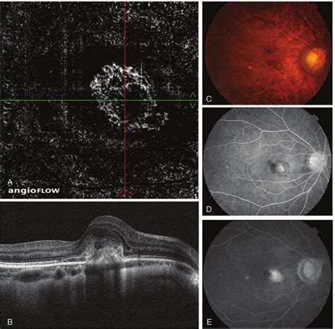 Rapid And Spontaneous Resolution Of Hemorrhagic Macular 59 OFF