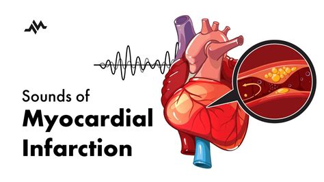 Sounds Of Myocardial Infarction Youtube