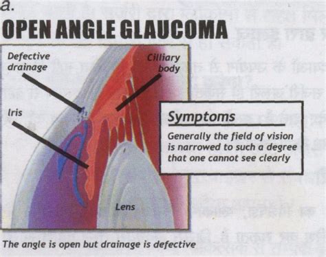 Open angle glaucoma - Health Vision