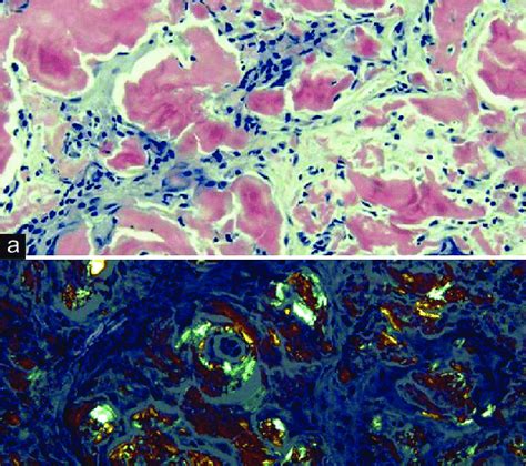 (a) Picture shows amyloid positivity with Congo red stain. (b ...